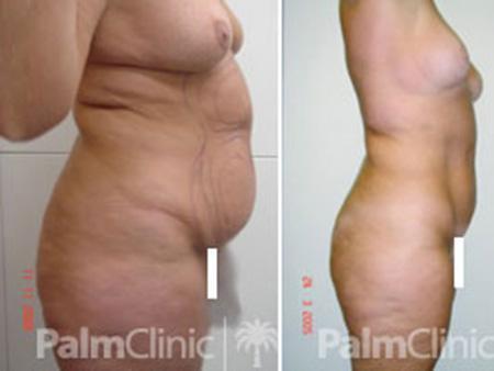 Before and after liposuction