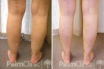 Cankles