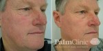 Facial Veins and Redness
