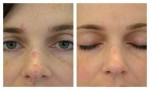 Facial Veins and Aurora IPL
