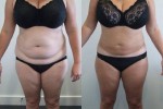 Abdomen and Waist Liposuction