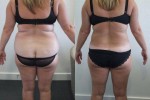 Hip and waist liposuction
