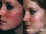 Rosacea before and after treatment