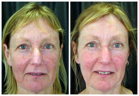 Severe rosacea treated with ELOS IPL