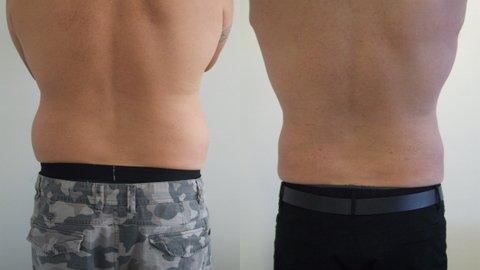 Lovehandles removed with Liposculpture