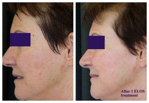 Sunspots Removed with ELOS