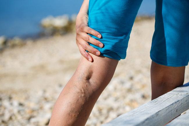 Varicose veins pain