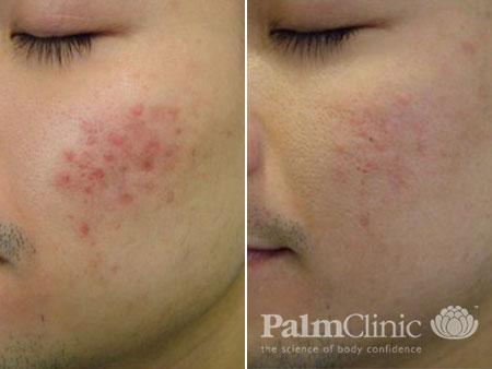 Acne scars respond well to fractional resurfacing with Fraxel laser.