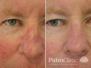 Facial and nasal veins before and after Elos IPL.