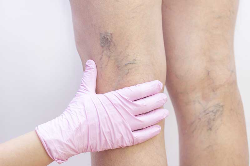 close up of the back of someone’s legs, with a gloved hand examining the varicose veins