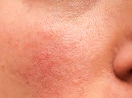 Cheek with case of Erythematotelangiectatic Rosacea