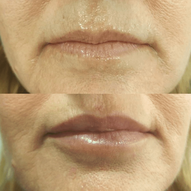 Lip Enhancement