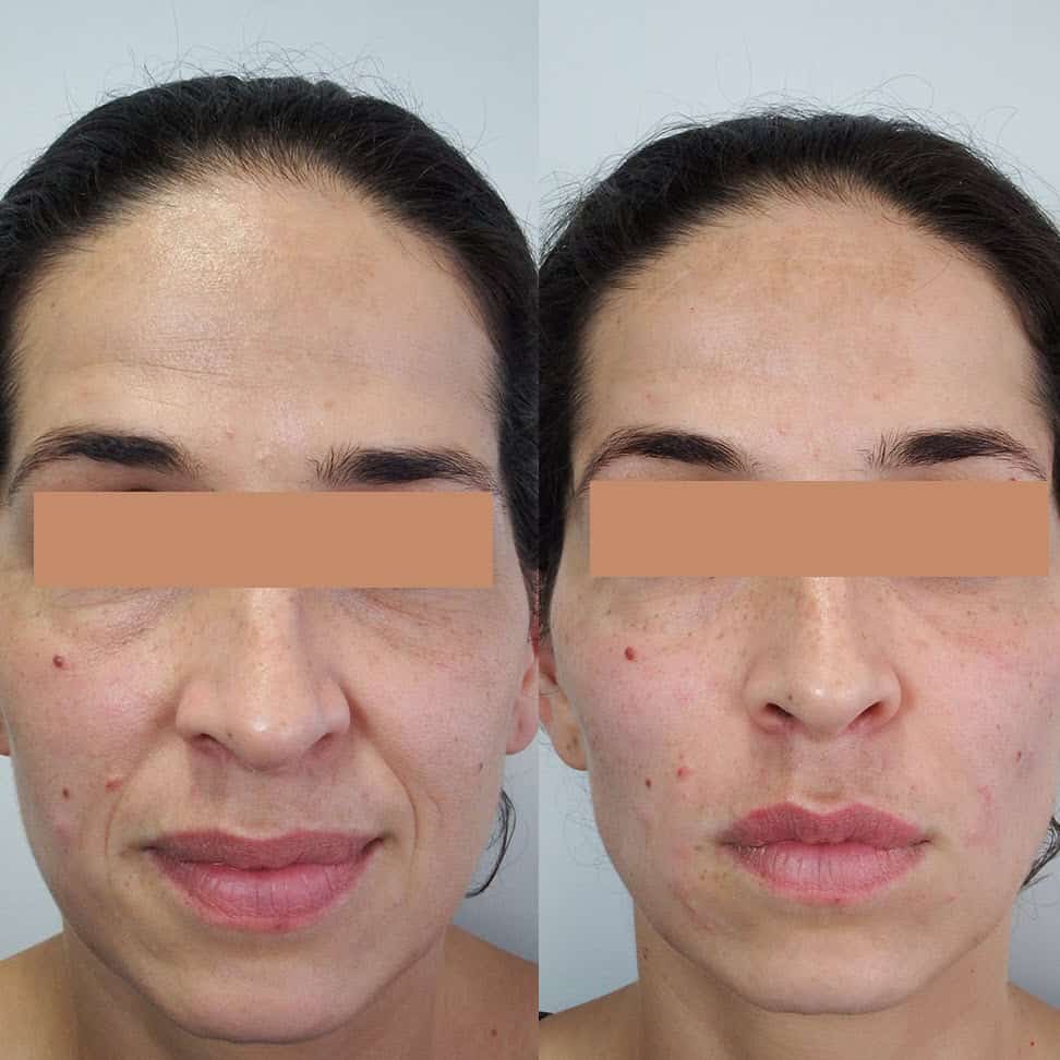 Liquid Facelift