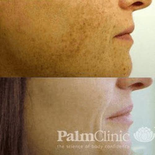 Pigmentation