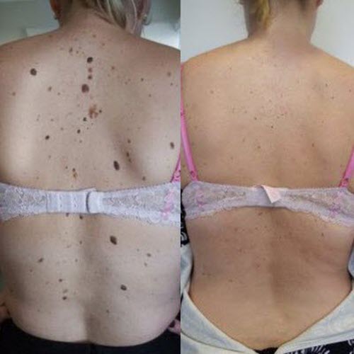 Mole Removal