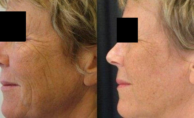 laser skin resurfacing