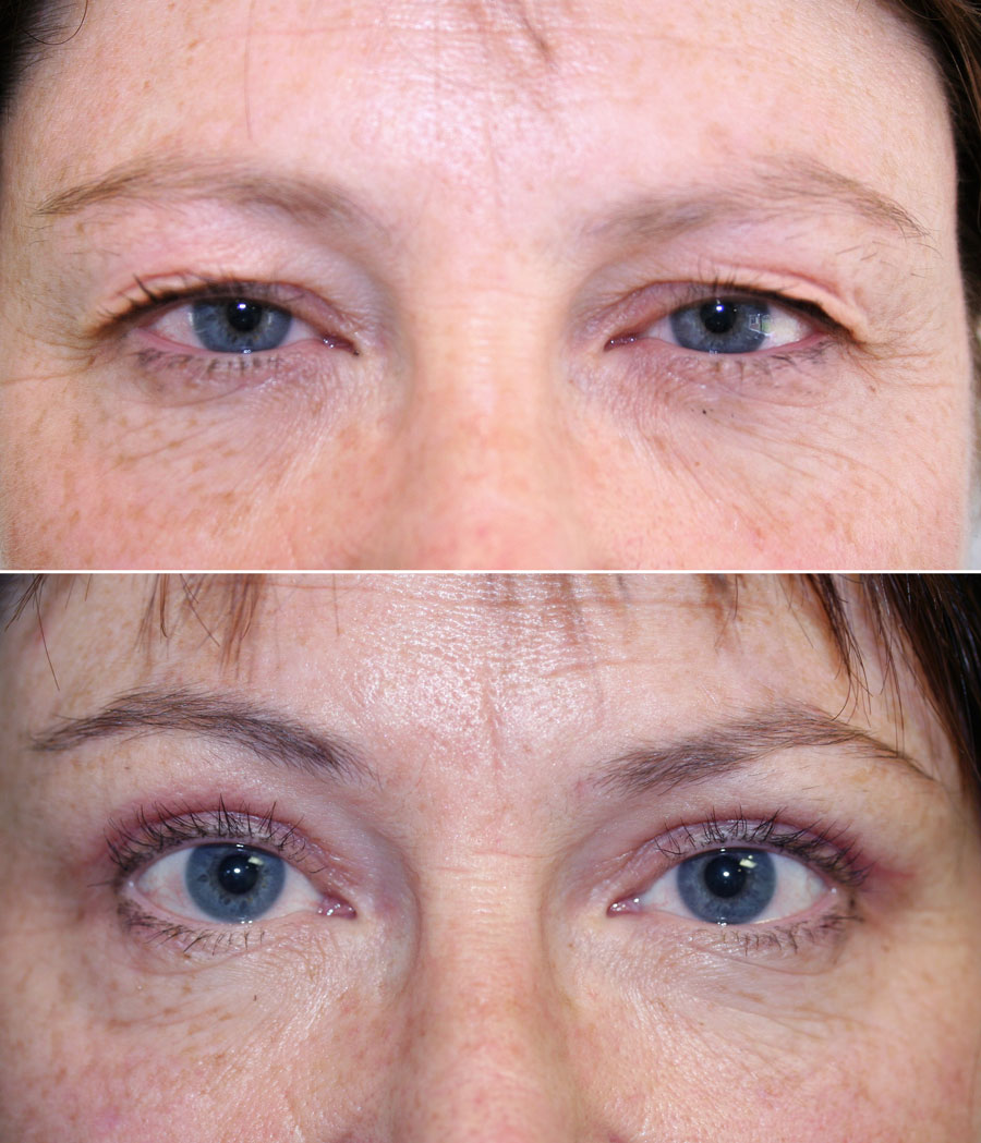 Eyelid Reduction - Before and after Blepharoplasty 