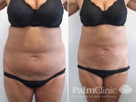 Liposculpture to the abdomen area