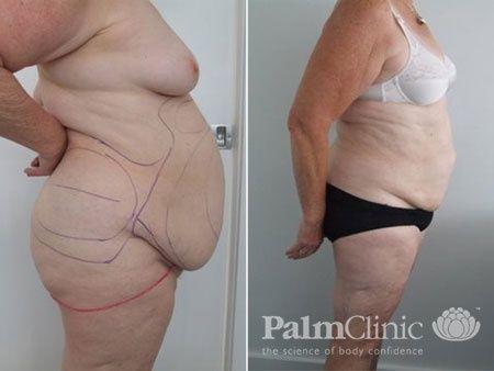 Liposuction of the abdomen for those who do not want a tummy tuck