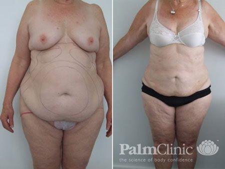 liposuction for those that do not want a tummy tuck