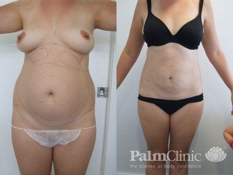 Liposculpture to the abdomen area