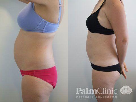 Abdomen liposuction