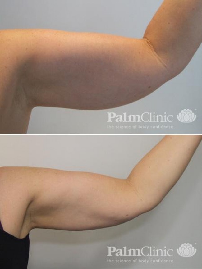 arm liposuction