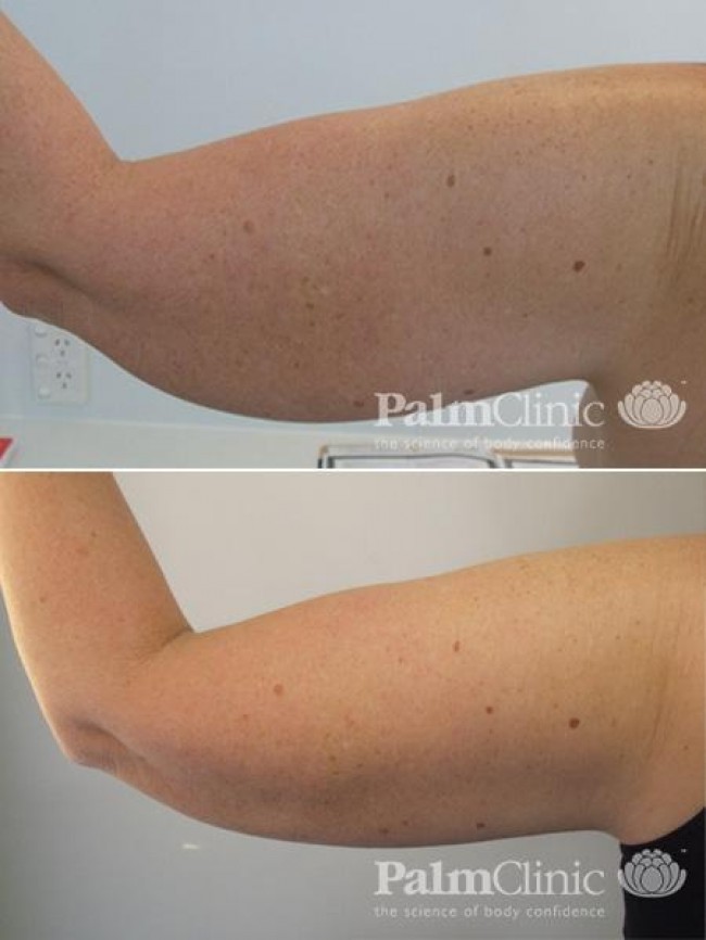 arm liposuction