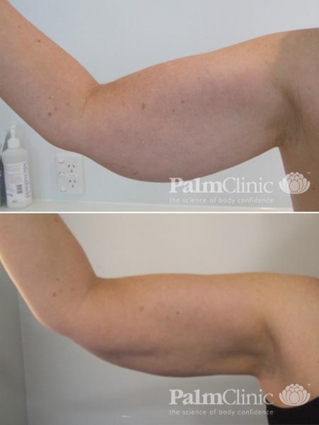 arm liposuction