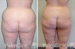 fat removal from buttocks and outer thighs