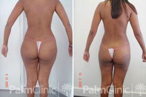 buttocks liposuction