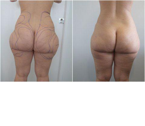 buttocks liposuction