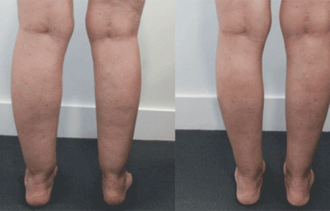 Calves and ankles liposculpture*