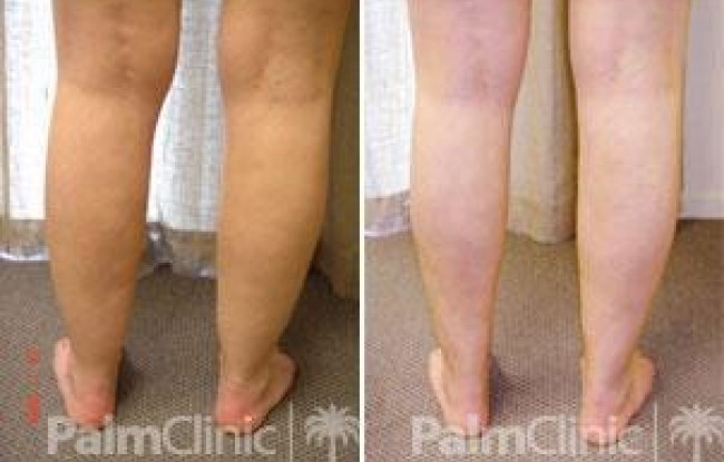 Liposculpture to calve and ankles