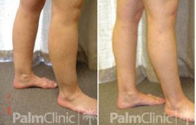 Liposuction of the calves