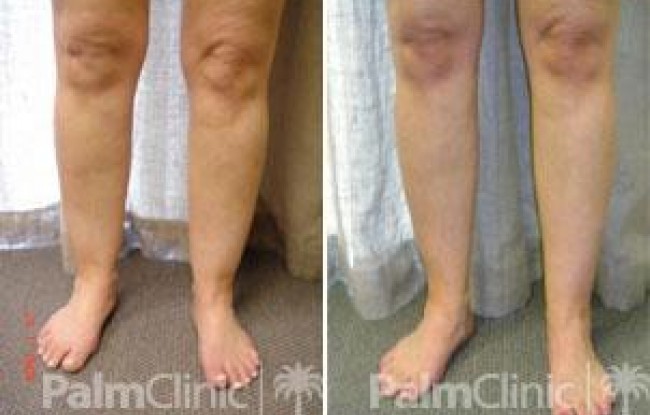 remove the excess fat and sculpture the lower leg