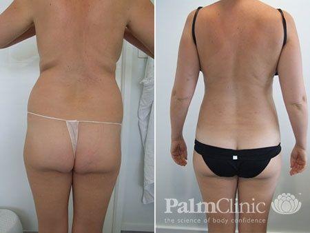 Flanks liposuction