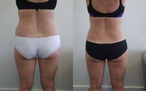 Hips liposuction