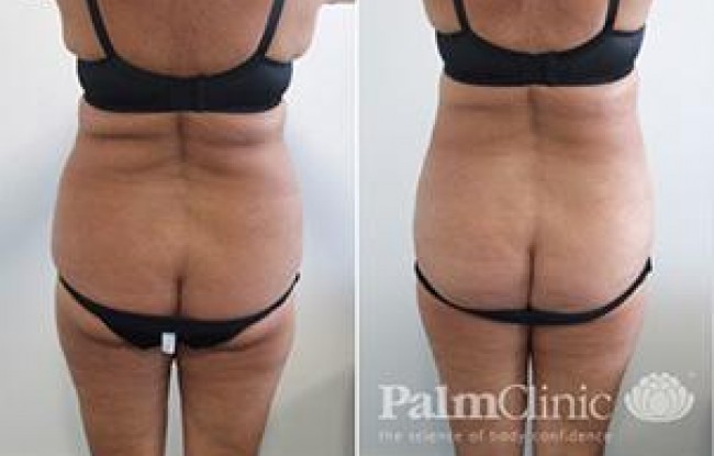 removing fat from below the bra strap area to improve the waist