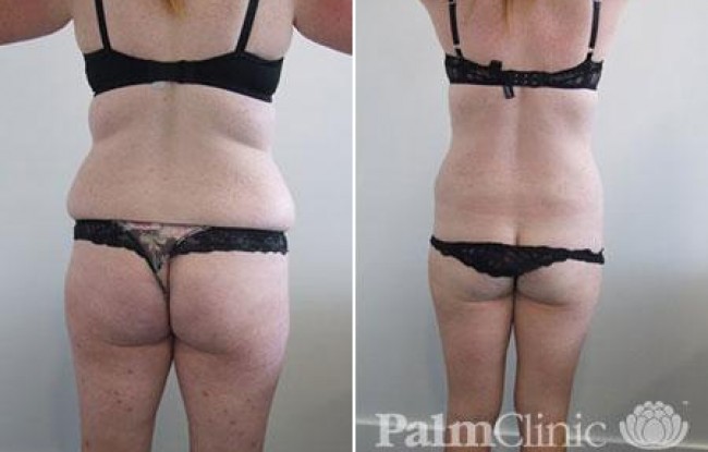 Poor skin elasticity can compromise results but still a significant improvement