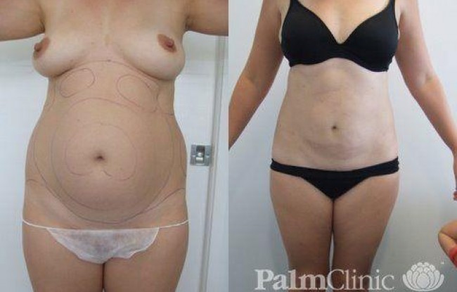 combine liposculpture to abdomen and hips to enhance the waist
