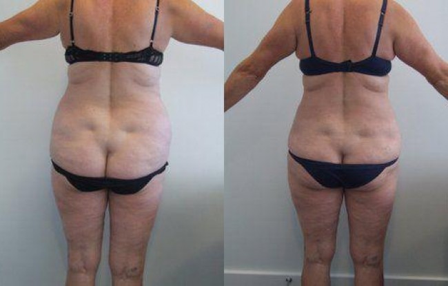 each hip was removed to produce a more youthful body contour 