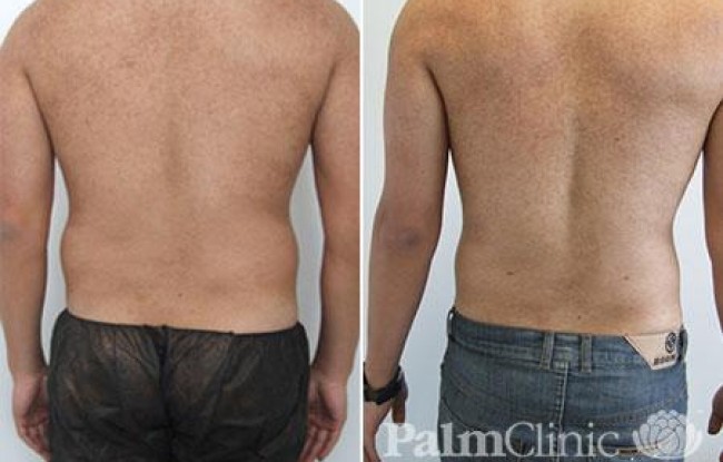 love handles have been treated with liposculpture
