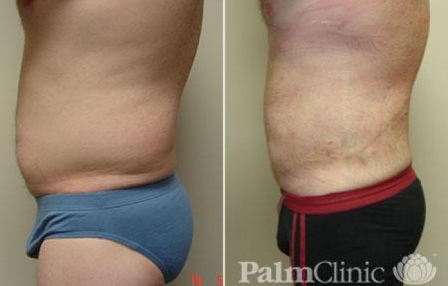 liposuction of the abdomen