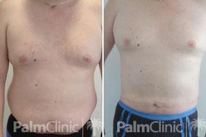 Male love handles liposuction