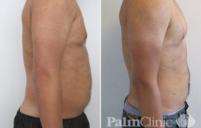  Male Love Handles Liposuction 