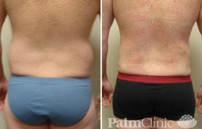 Love handles in men respond well to liposculpture.