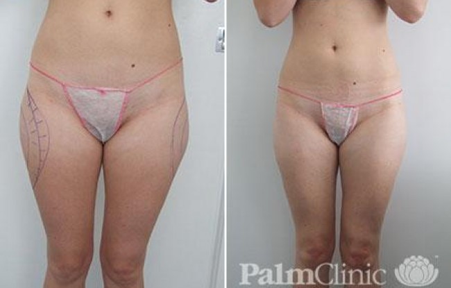 Removal of "saddle bags" or outer thighs using liposuction