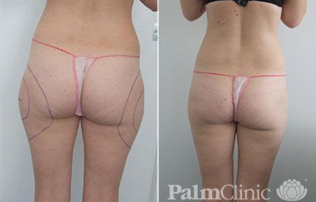 The outer thighs (often called saddle bags) have been treated with liposculpture