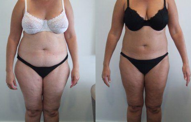 outer and inner thighs have been treated with liposculpture